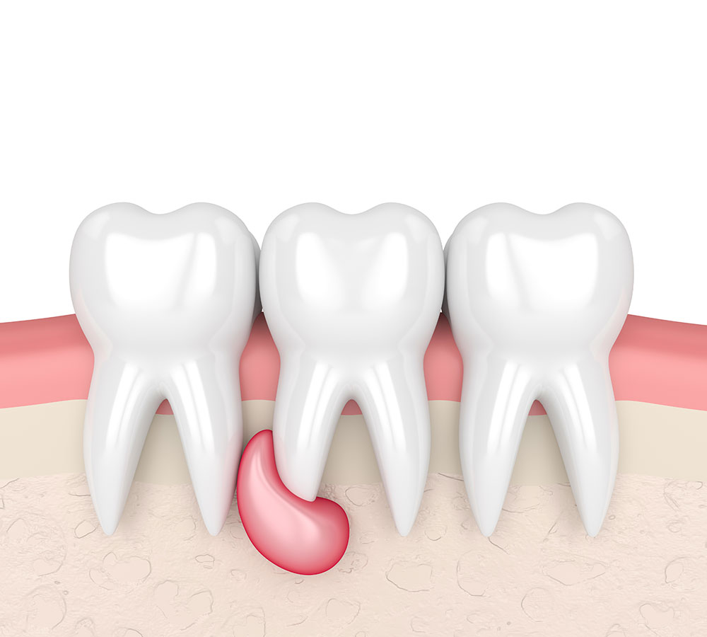 Cistectomia | Ciste dentale | Odontoiatria Chirurgica | Servizi Udental Milano