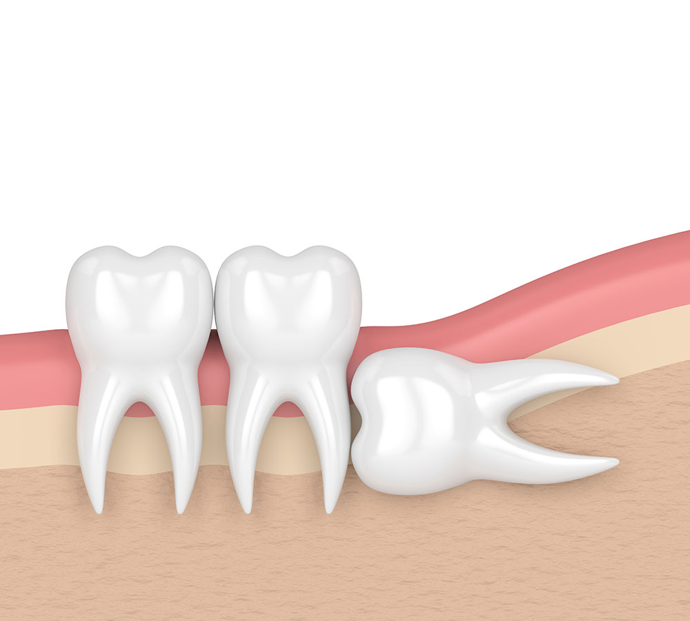 Estrazione dente del giudizio incluso | Odontoiatria Chirurgica | Servizi Udental Milano