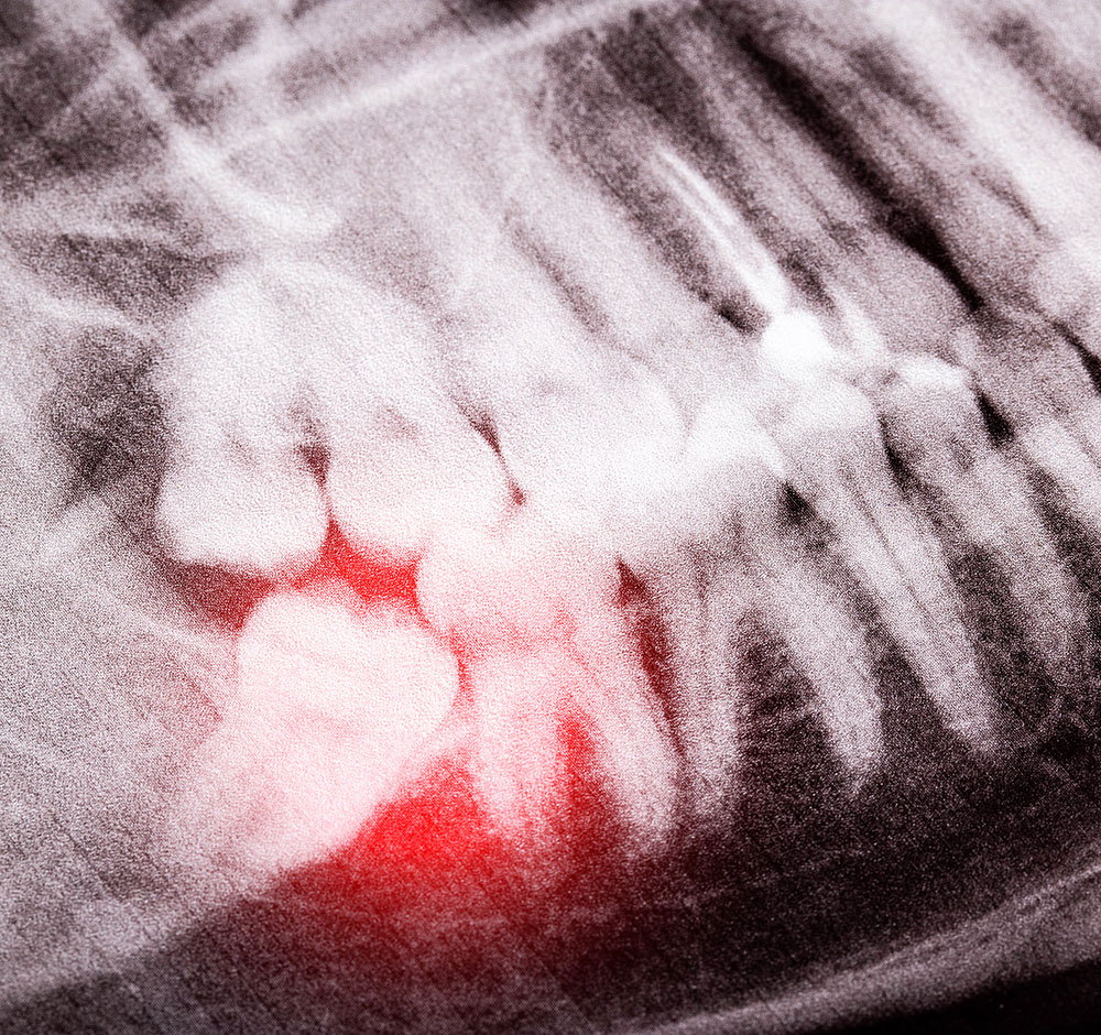 Rimozione denti distopici | Odontoiatria Chirurgica | Servizi Udental Milano